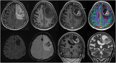 Structured Reporting in Neuroradiology: Intracranial Tumors